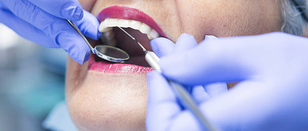 Best Knocked-Out Tooth (Avulsed Tooth) Treatment in Cedar Springs, MI